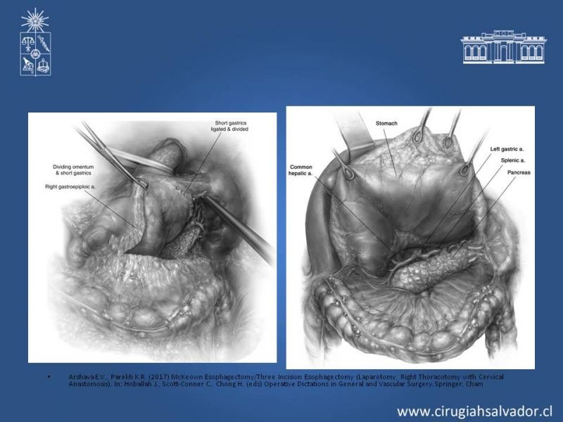 Diapositiva 6 de Esofagectomia: McKeown e Ivor Lewis
