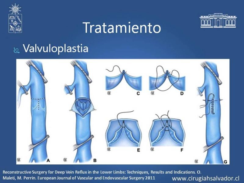 Diapositiva 20 de Síndrome Post Flebítico (SPF)