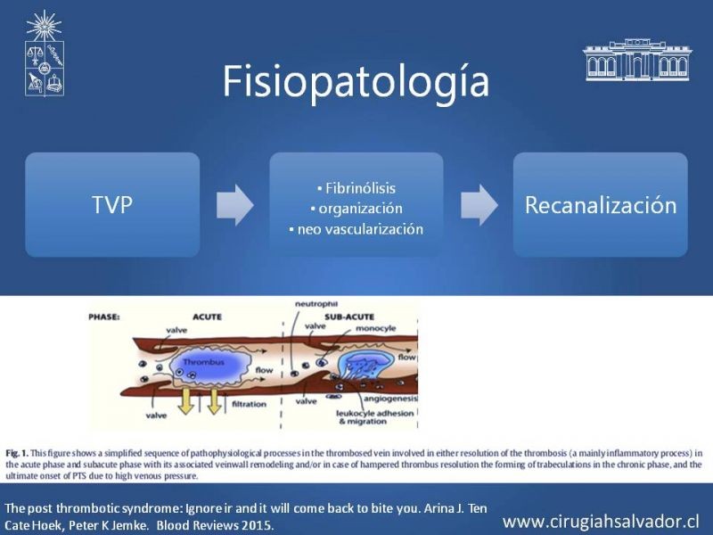 Diapositiva 4 de Síndrome Post Flebítico (SPF)