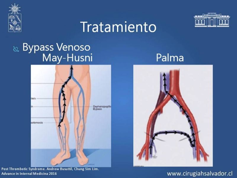 Diapositiva 18 de Síndrome Post Flebítico (SPF)