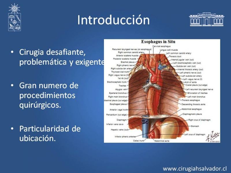 Diapositiva 1 de Esofagectomia: McKeown e Ivor Lewis