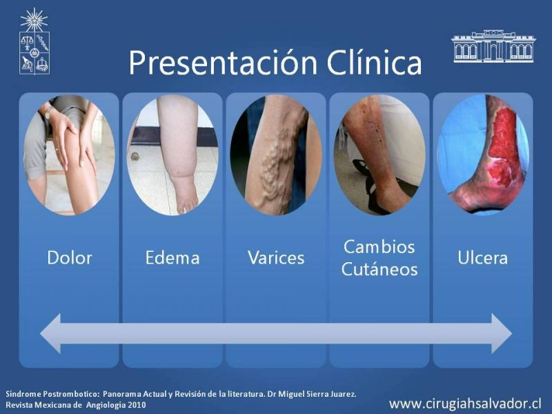 Diapositiva 7 de Síndrome Post Flebítico (SPF)