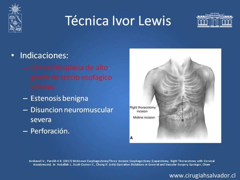 Diapositiva 2 de Esofagectomia: McKeown e Ivor Lewis