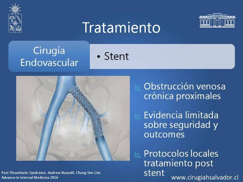 Diapositiva 16 de Síndrome Post Flebítico (SPF)