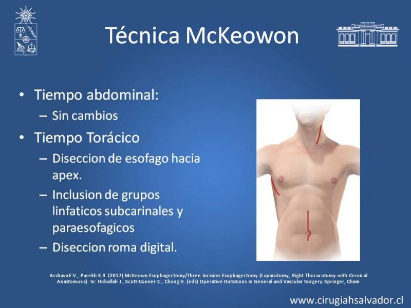 Diapositiva 12 de Esofagectomia: McKeown e Ivor Lewis