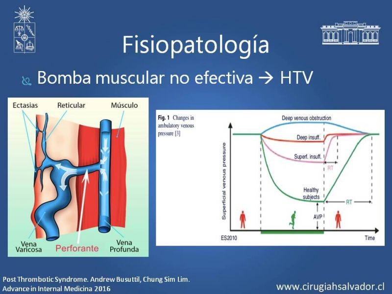 Diapositiva 6 de Síndrome Post Flebítico (SPF)
