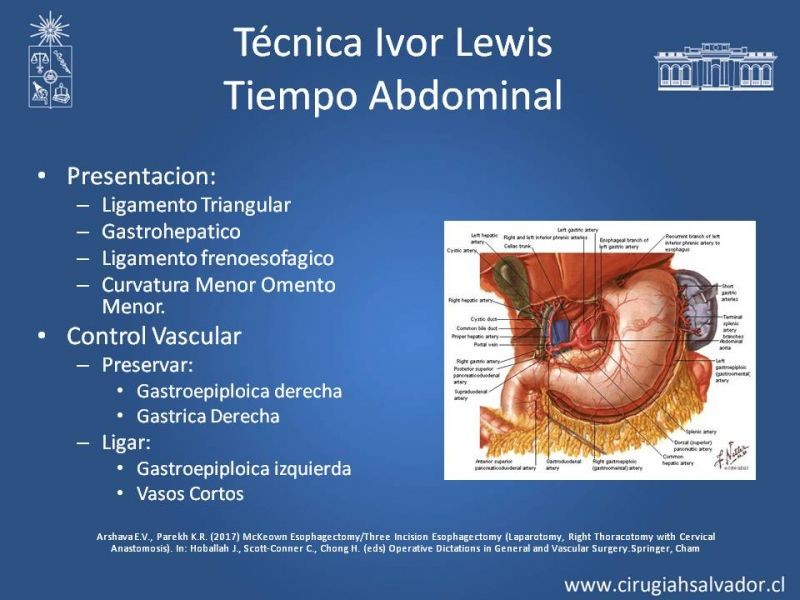 Diapositiva 3 de Esofagectomia: McKeown e Ivor Lewis