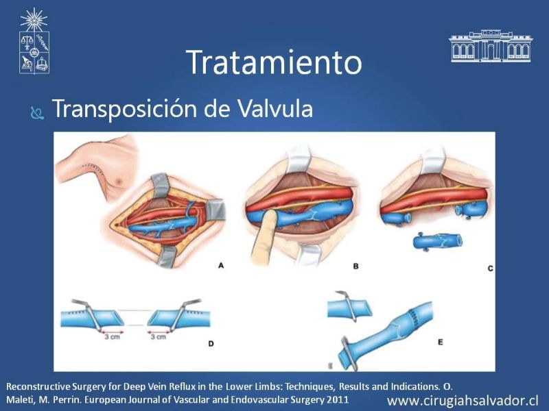 Diapositiva 19 de Síndrome Post Flebítico (SPF)