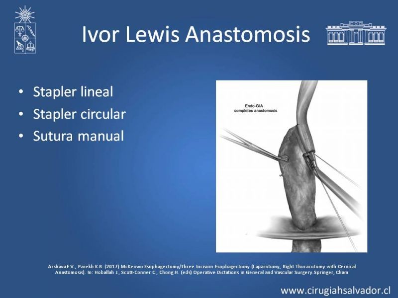 Diapositiva 8 de Esofagectomia: McKeown e Ivor Lewis