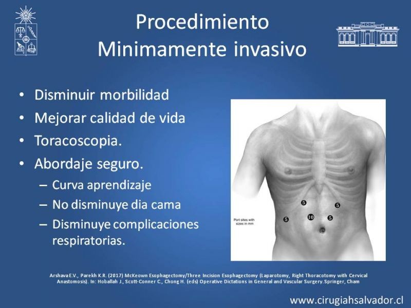 Diapositiva 14 de Esofagectomia: McKeown e Ivor Lewis