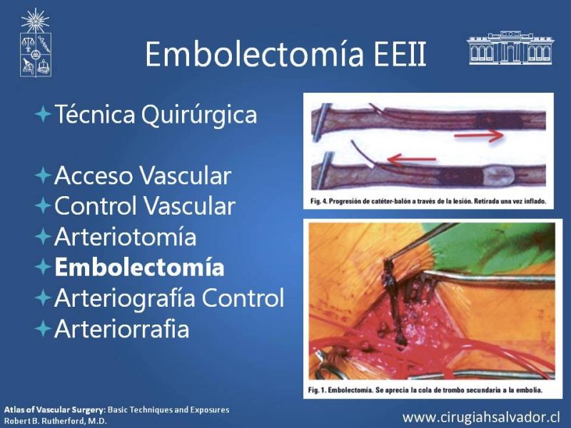 Diapositiva 16 de Isquemia Aguda de Extremidades Inferiores