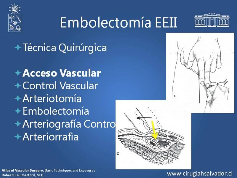 Diapositiva 13 de Isquemia Aguda de Extremidades Inferiores