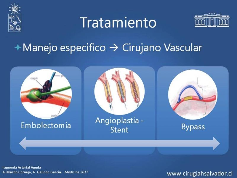 Diapositiva 11 de Isquemia Aguda de Extremidades Inferiores