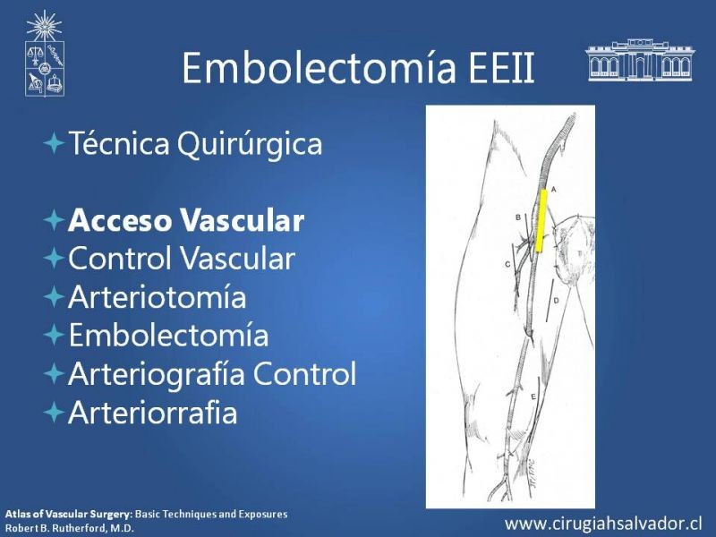 Diapositiva 12 de Isquemia Aguda de Extremidades Inferiores
