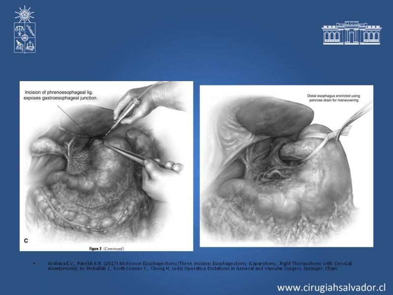 Diapositiva 5 de Esofagectomia: McKeown e Ivor Lewis