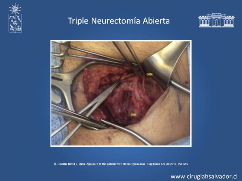 Diapositiva 25 de Manejo de Inguinodinia post Hernioplastía Inguinal