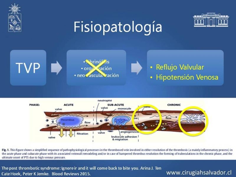 Diapositiva 5 de Síndrome Post Flebítico (SPF)