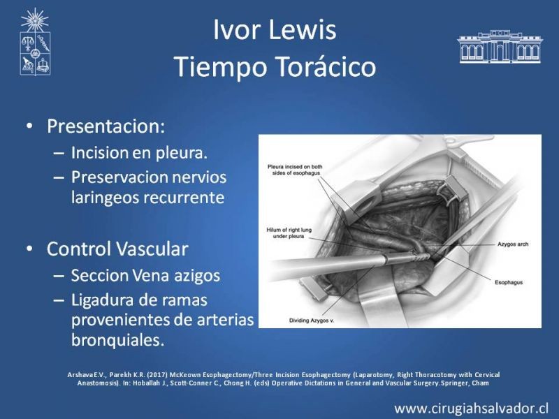 Diapositiva 7 de Esofagectomia: McKeown e Ivor Lewis