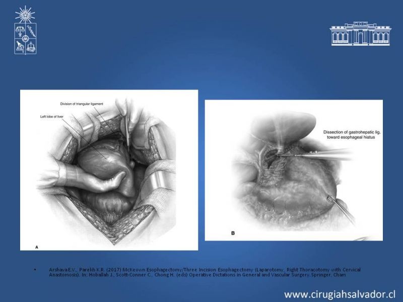 Diapositiva 4 de Esofagectomia: McKeown e Ivor Lewis