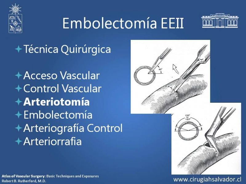 Diapositiva 15 de Isquemia Aguda de Extremidades Inferiores