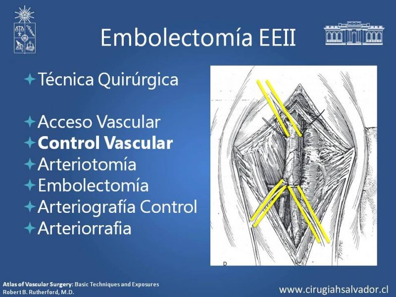 Diapositiva 14 de Isquemia Aguda de Extremidades Inferiores