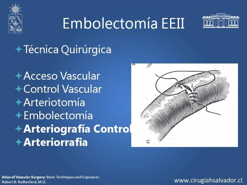 Diapositiva 17 de Isquemia Aguda de Extremidades Inferiores