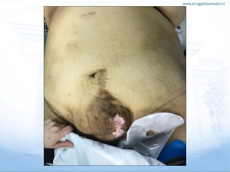 Diapositiva 4 de Cirugía bariátrica como puente en pacientes obesos con hernias complejas