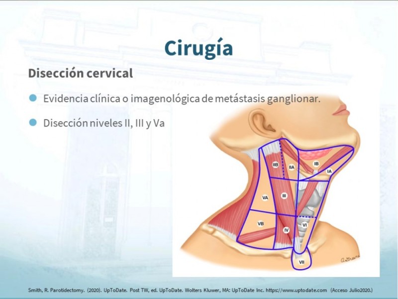 Diapositiva 25 de Tumores de Parótida