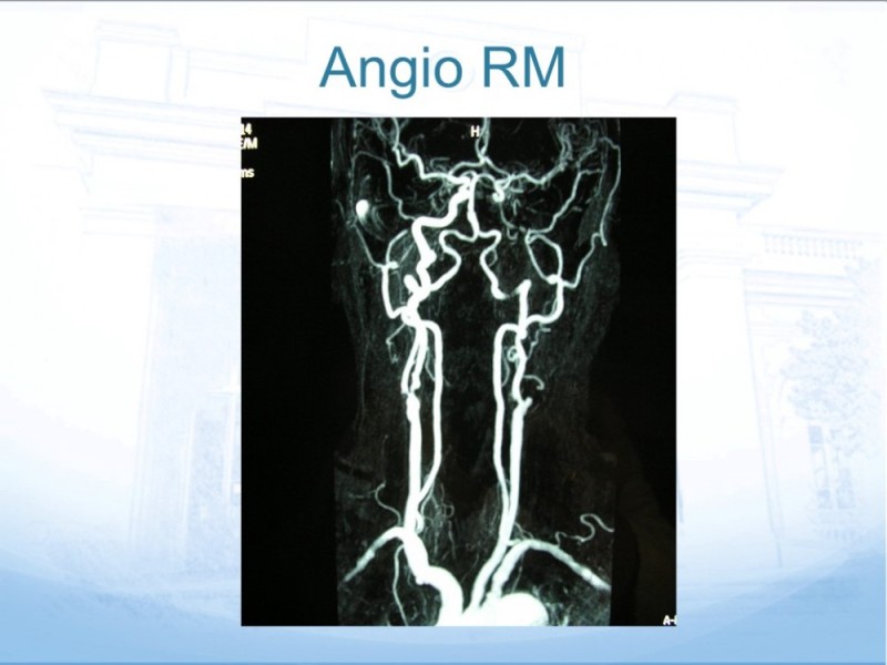 Diapositiva 20 de Estenosis Carotídea