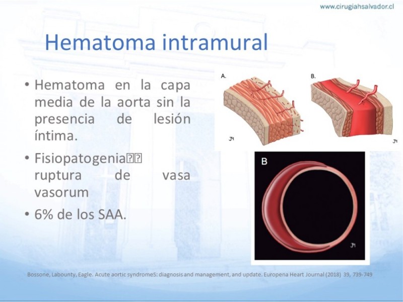 Diapositiva 5 de Síndrome Aórtico Agudo