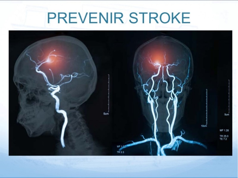 Diapositiva 2 de Estenosis Carotídea