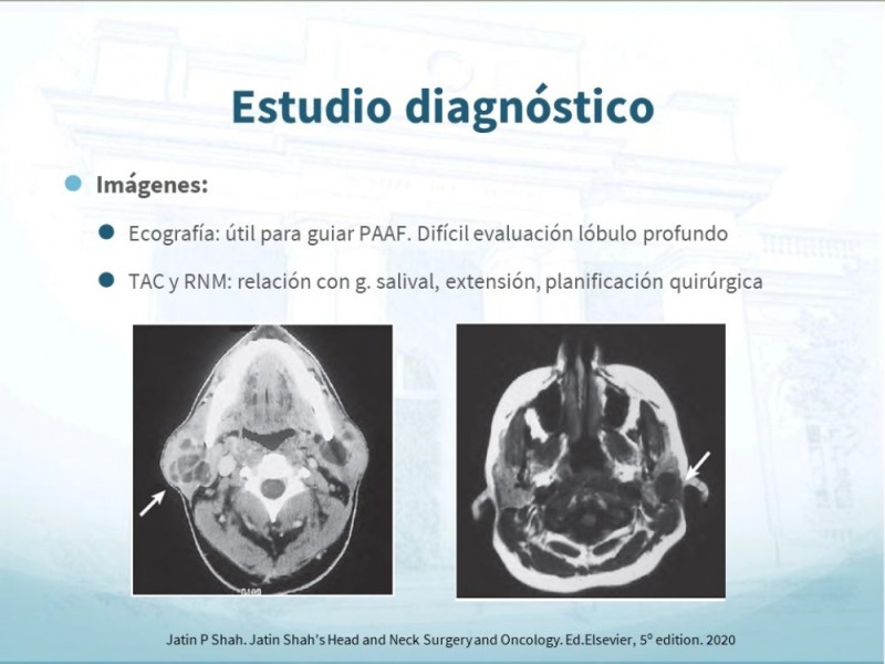 Diapositiva 10 de Tumores de Parótida