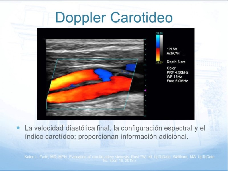 Diapositiva 16 de Estenosis Carotídea