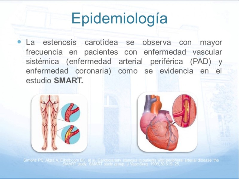 Diapositiva 4 de Estenosis Carotídea