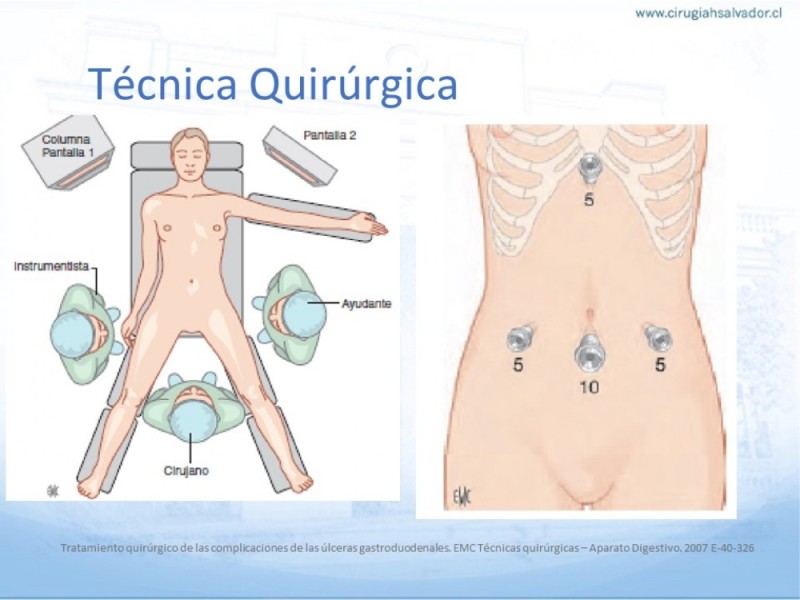 Diapositiva 13 de Úlcera Péptica Perforada