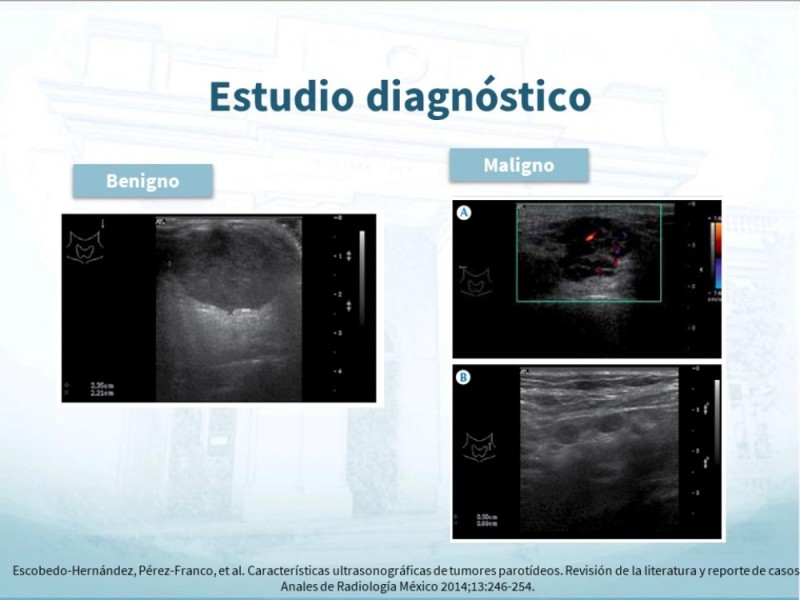 Diapositiva 11 de Tumores de Parótida
