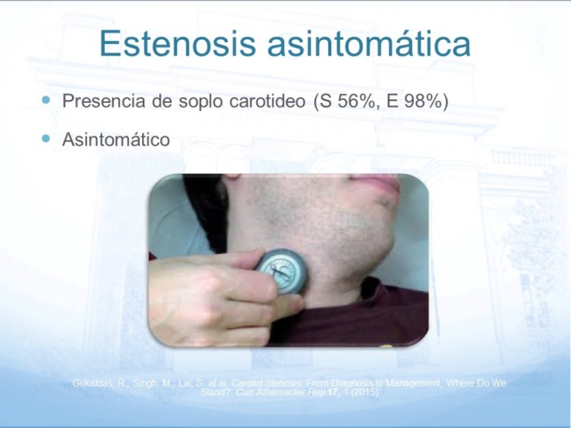 Diapositiva 10 de Estenosis Carotídea