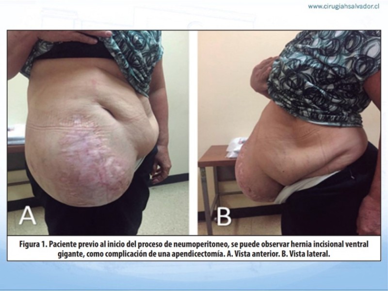 Diapositiva 5 de Cirugía bariátrica como puente en pacientes obesos con hernias complejas
