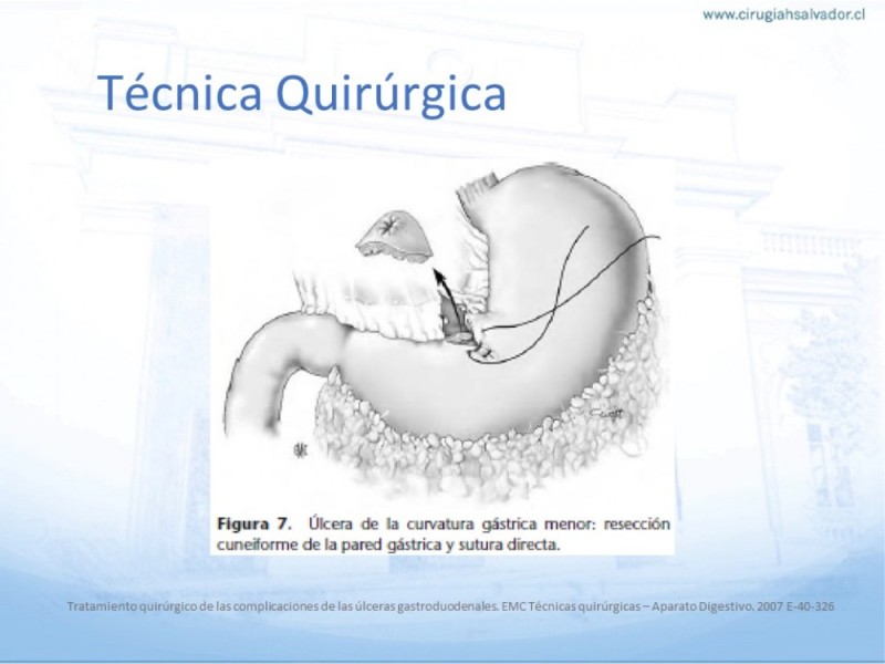 Diapositiva 16 de Úlcera Péptica Perforada