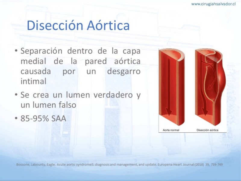 Diapositiva 7 de Síndrome Aórtico Agudo