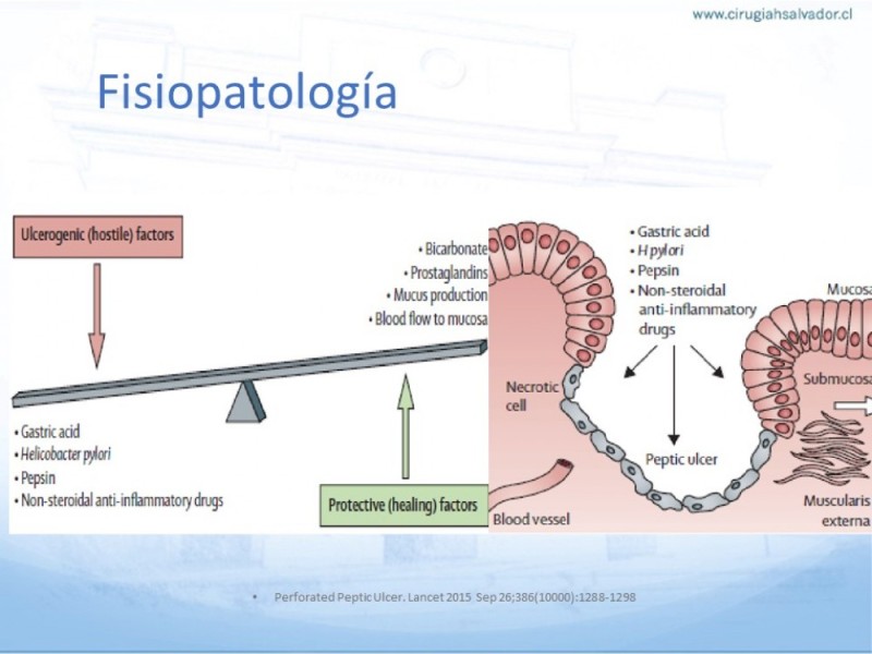 Diapositiva 3 de Úlcera Péptica Perforada