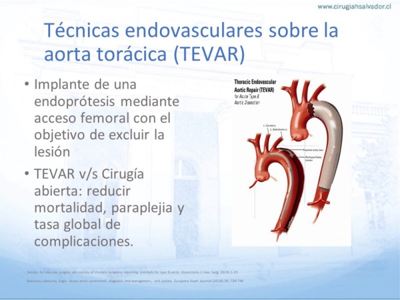 Diapositiva 21 de Síndrome Aórtico Agudo