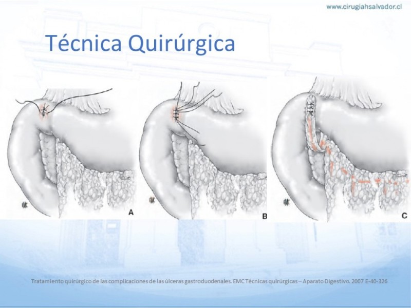 Diapositiva 14 de Úlcera Péptica Perforada