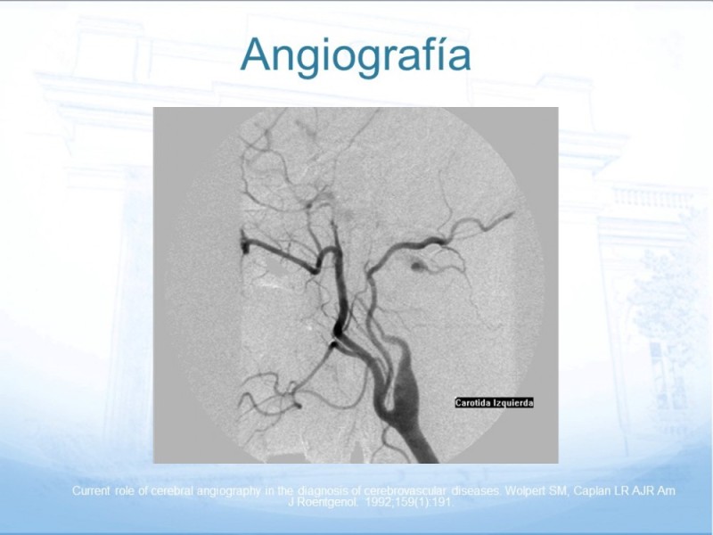 Diapositiva 24 de Estenosis Carotídea