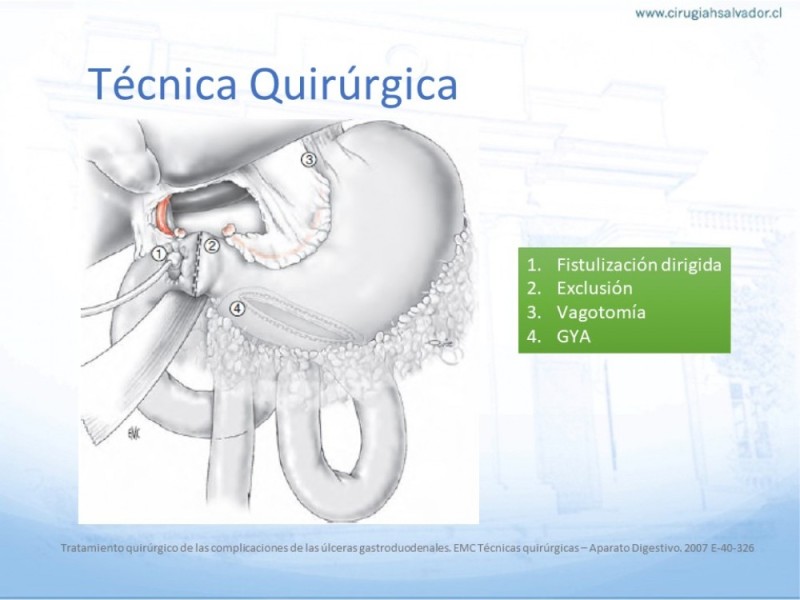 Diapositiva 15 de Úlcera Péptica Perforada