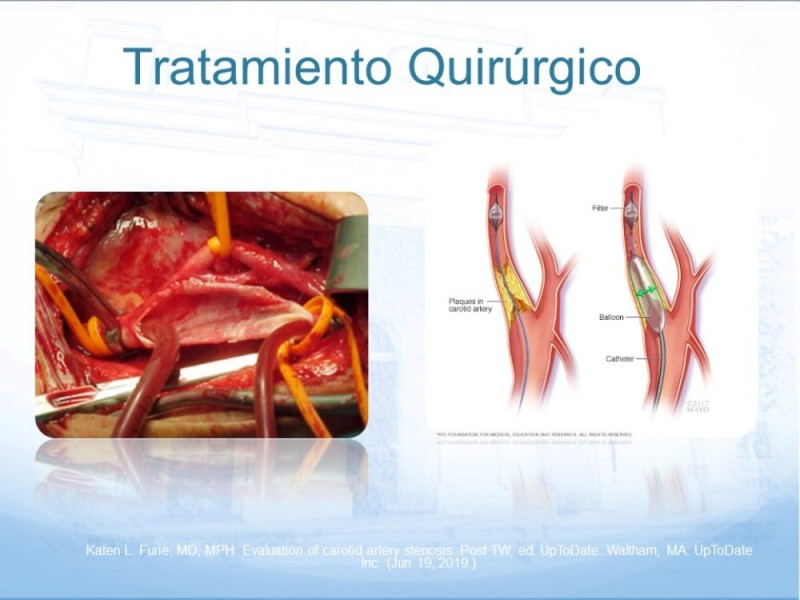 Diapositiva 33 de Estenosis Carotídea