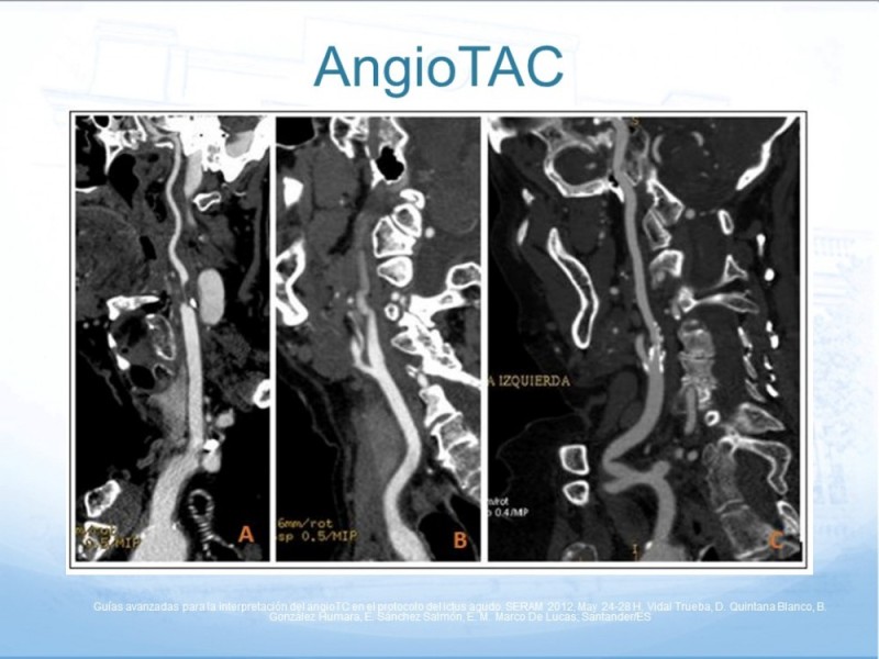 Diapositiva 22 de Estenosis Carotídea