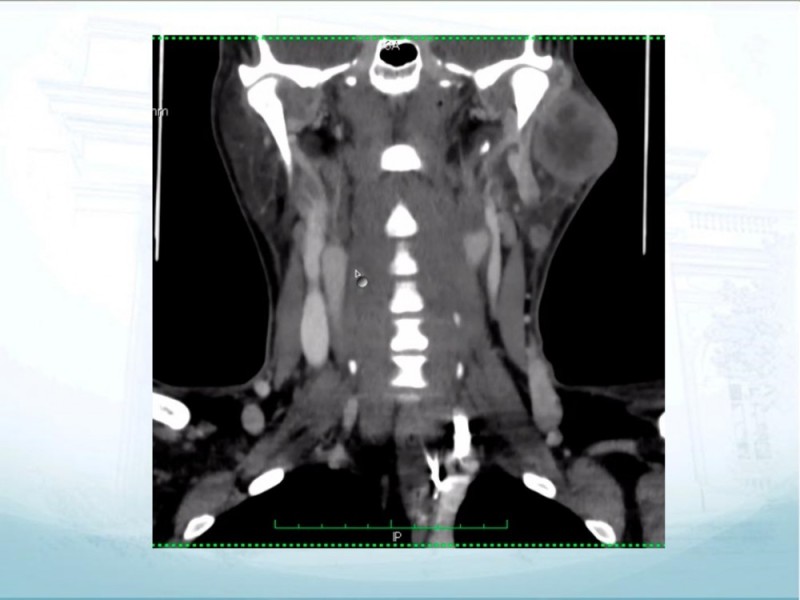 Diapositiva 12 de Tumores de Parótida