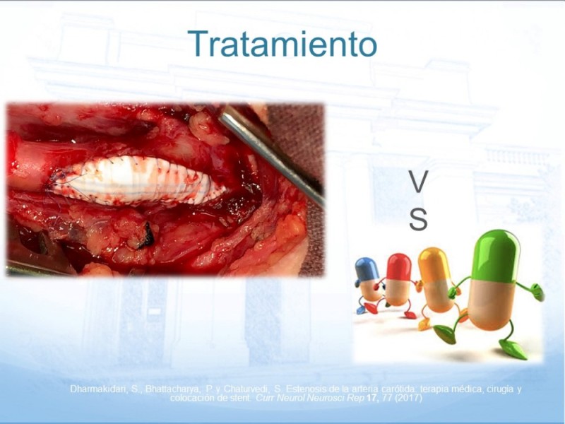 Diapositiva 27 de Estenosis Carotídea