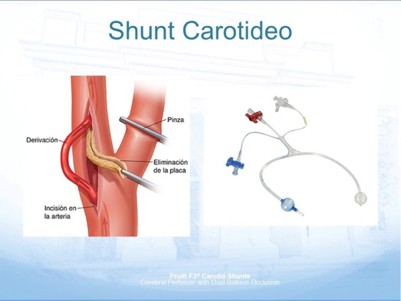 Diapositiva 35 de Estenosis Carotídea